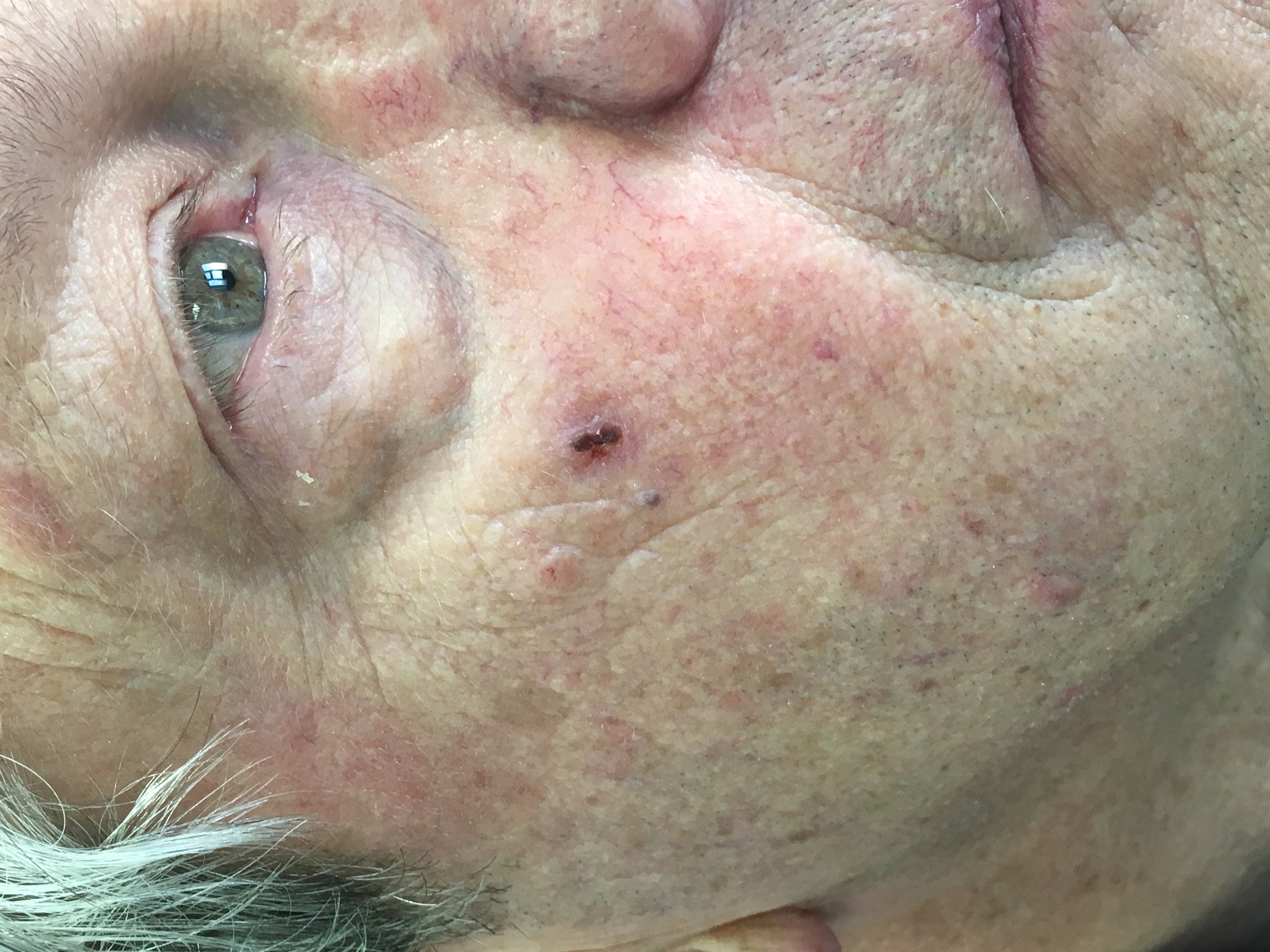 Dermatological disorders